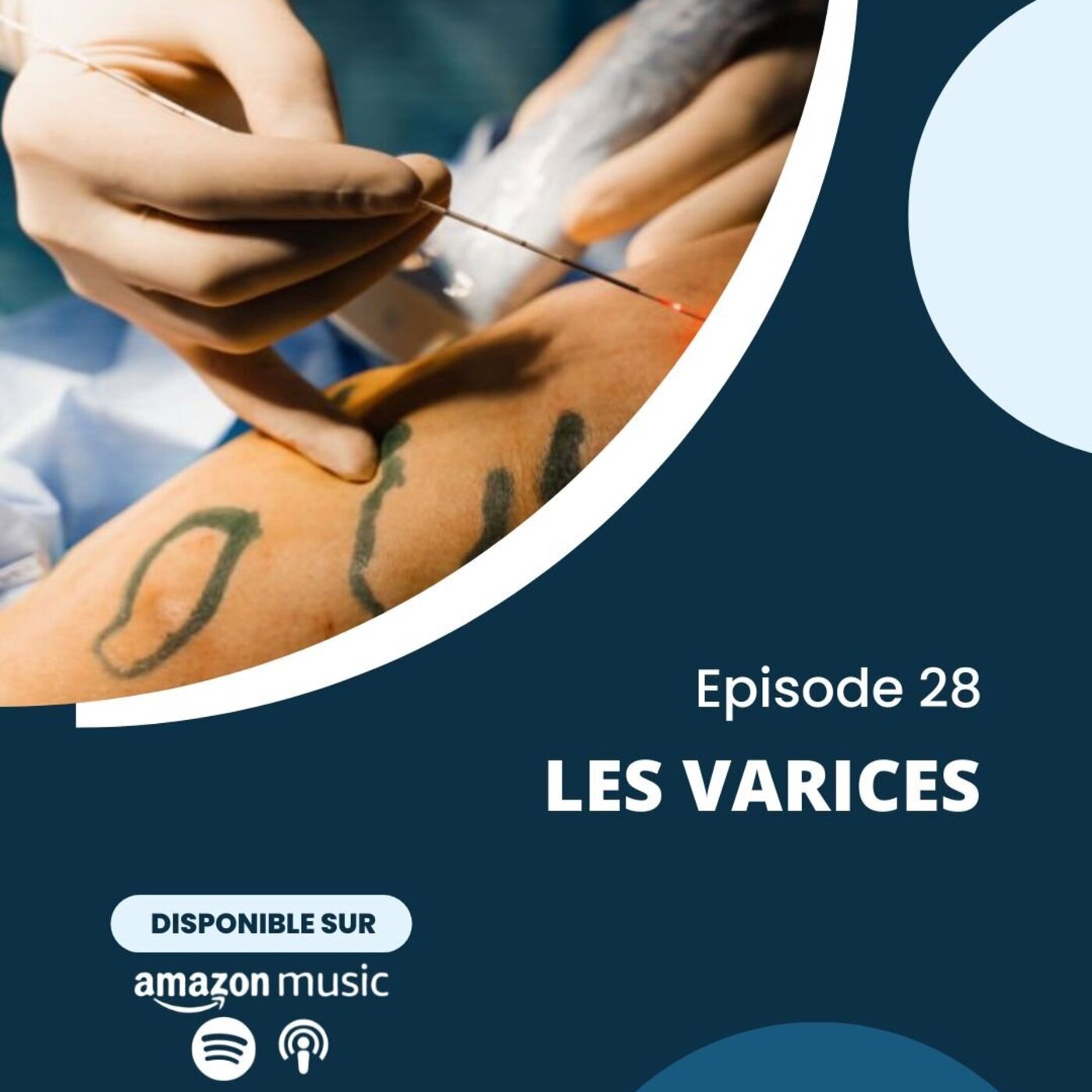 Varices