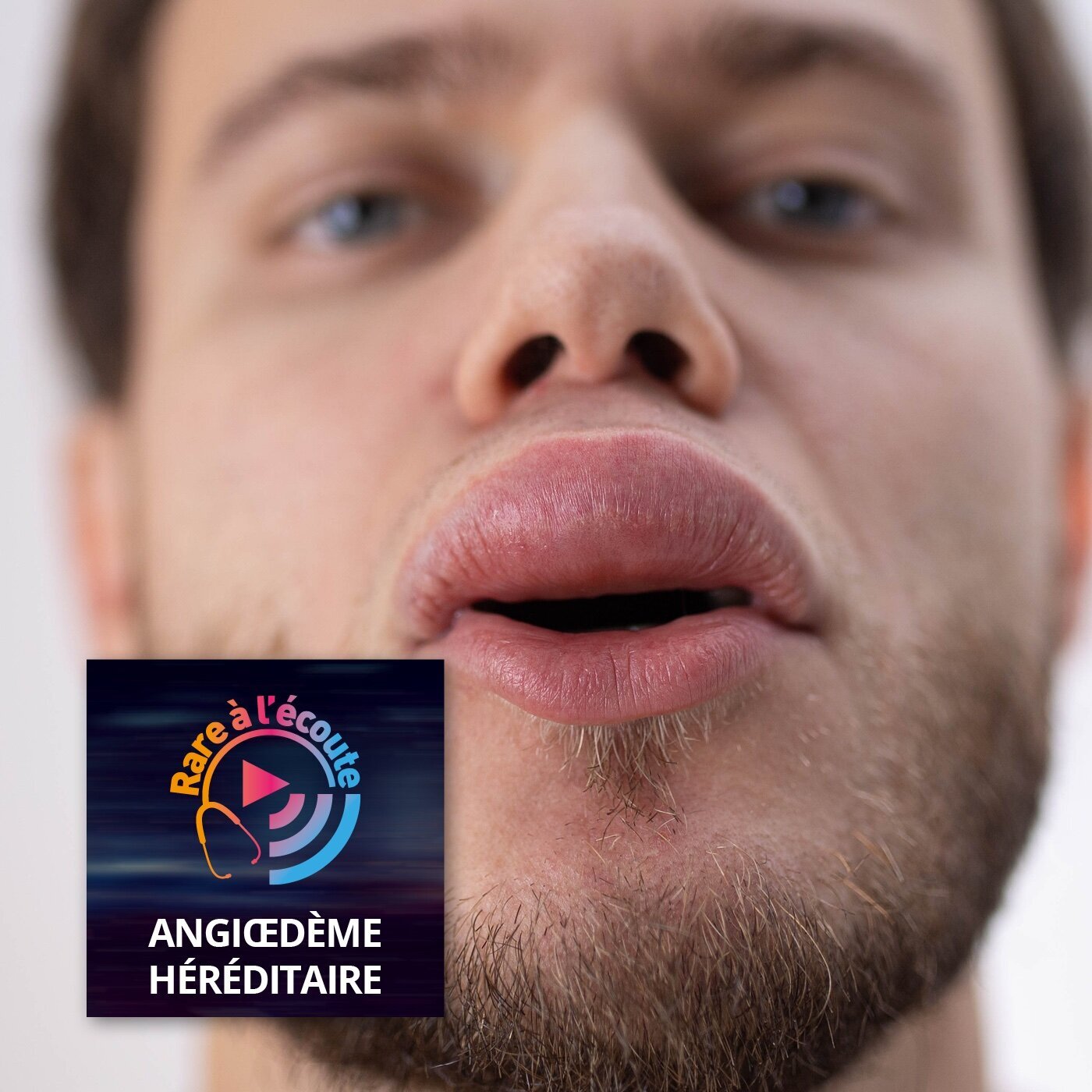 Maladie rare – Qu'appelle-t-on angiœdème héréditaire ? episode artwork